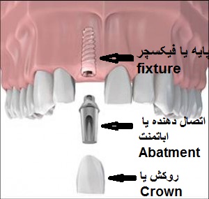ایمپلنت دندان در یزد