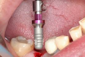 ایمپلنت دندان به روش پانچ