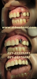 گالری عکسهای کاشت ایمپلنت دندان